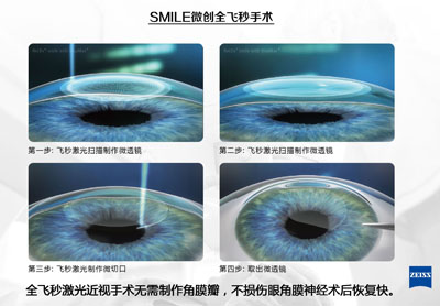 准分子激光和飞秒激光的区别？