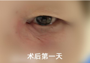 谁懂啊！急性泪囊炎遭大罪，*还不疼！